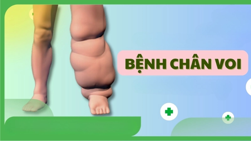 Hình ảnh bệnh phù chân voi và cách nhận biết sớm