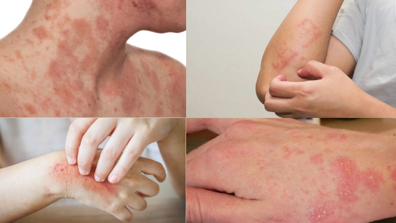 Hình ảnh bệnh nấm da phổ biến và cách nhận biết sớm