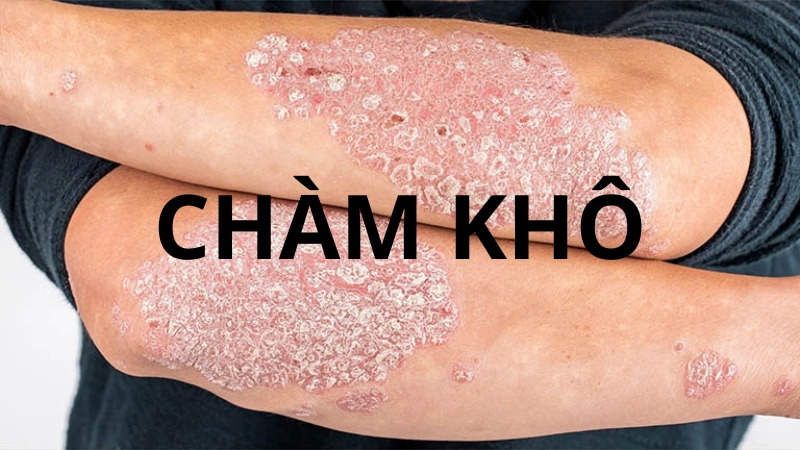 Nhận diện sớm qua hình ảnh bệnh chàm khô thường gặp