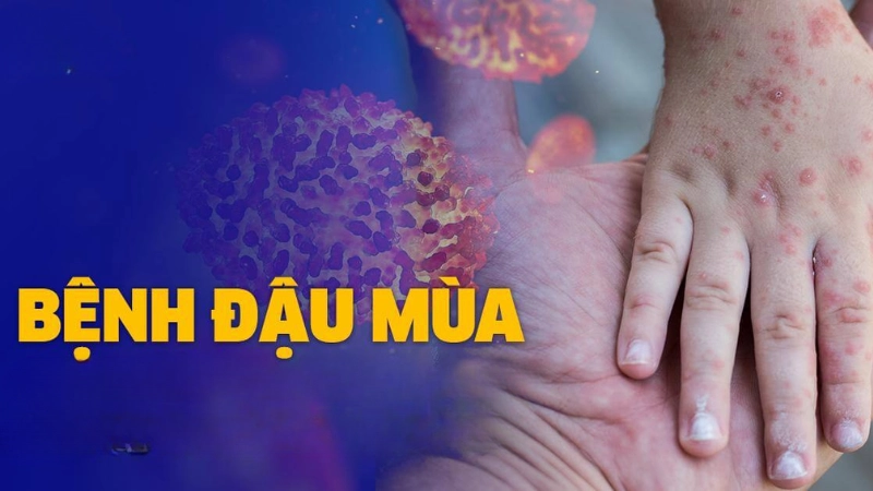 Hình ảnh bệnh đậu mùa ở người lớn và trẻ nhỏ dễ nhận biết