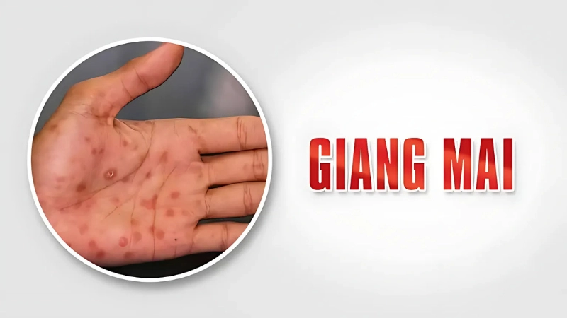 Hình ảnh bệnh giang mai ở nam và nữ qua từng giai đoạn