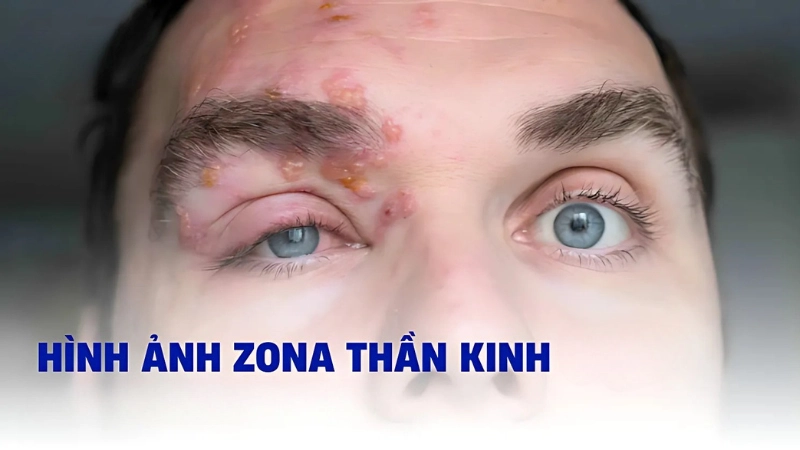 Hình ảnh bệnh zona thần kinh ở mắt và dấu hiệu nhận biết