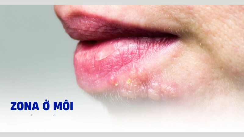 Hình ảnh bệnh zona ở môi do virus tái hoạt động