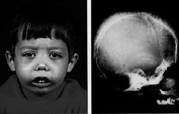 Tìm hiểu bệnh máu tan nhanh qua ảnh minh họa cụ thể rõ ràng