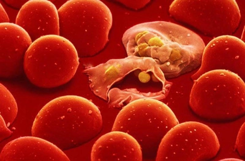 Tổng hợp hình ảnh bệnh tan máu bẩm sinh thể nhẹ dễ quan sát