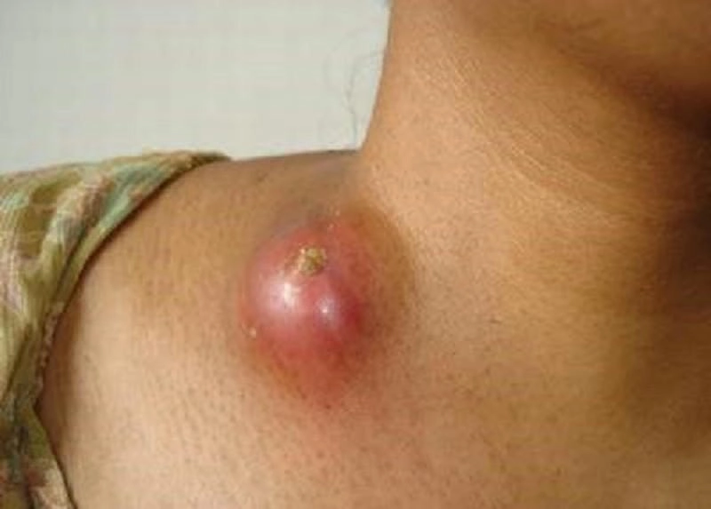 Triệu chứng thường gặp của bệnh lao hạch