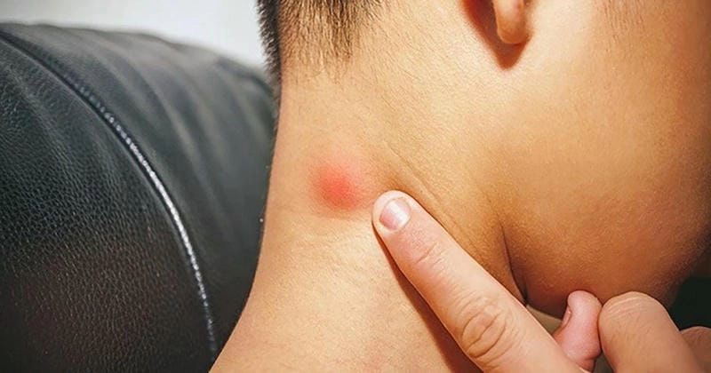 Phát hiện sớm lao hạch ở trẻ em giúp điều trị hiệu quả