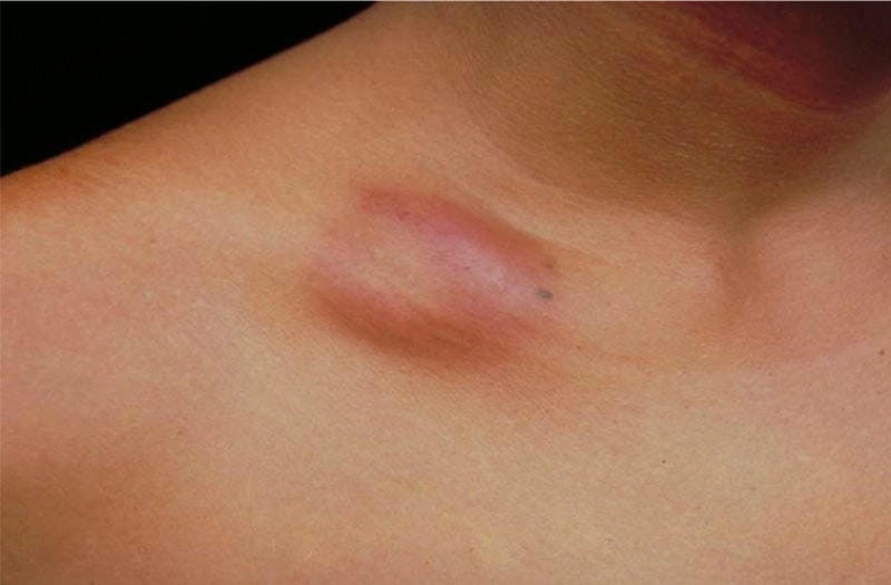 Cách điều trị bệnh lao hạch ở trẻ em đúng hướng