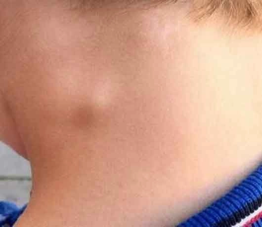 Phòng tránh hiệu quả lao hạch di chứng sau điều trị