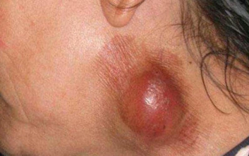 Biện pháp phòng ngừa lao hạch tái phát hiệu quả