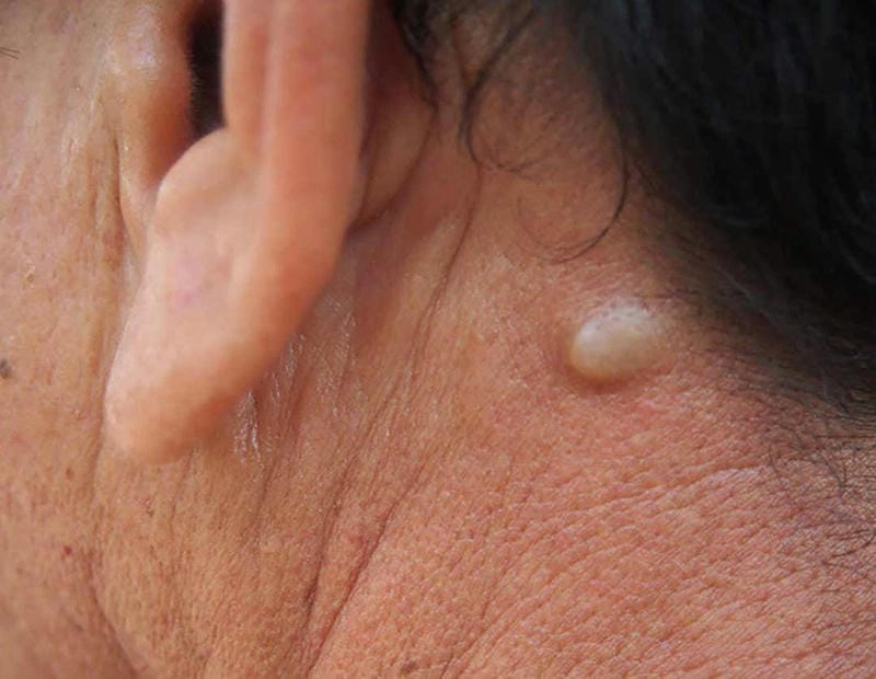 Khám phá các hình ảnh hạch lao cổ rõ nét