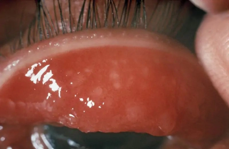 Chẩn đoán từ ảnh mắt bị đau mắt hột chính xác