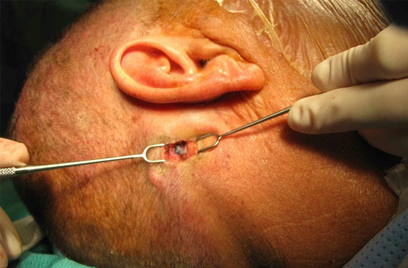 Khám phá bộ sưu tập hình ảnh lao hạch