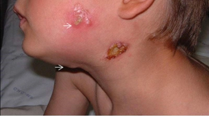 Các trường hợp phổ biến lao hạch ở cổ