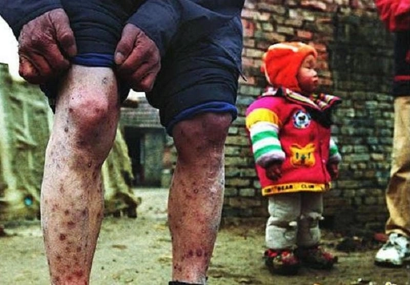 Tổng hợp những hình ảnh về hiv đáng chú ý