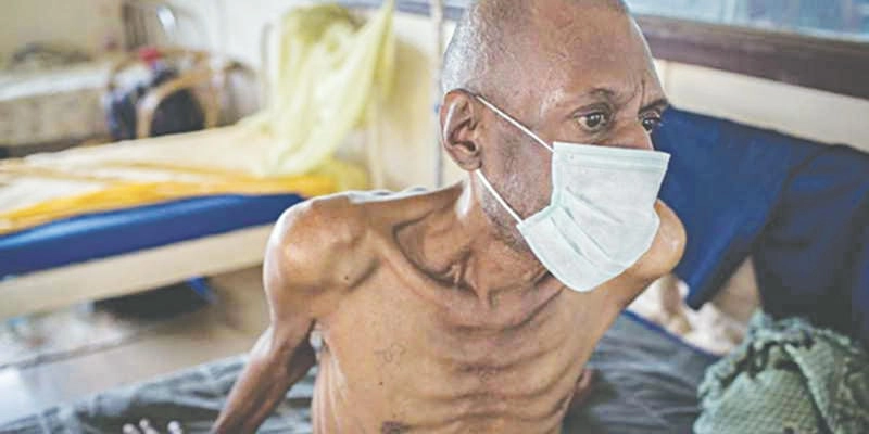 Cảnh báo từ hình ảnh hiv giai đoạn cuối đau lòng