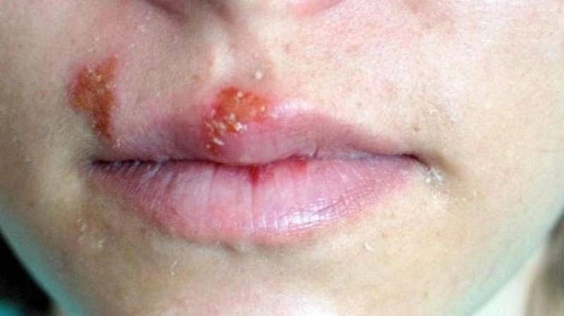 Giáo dục cộng đồng qua hình ảnh về hiv/aids