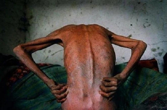 Nhận diện bệnh qua hình ảnh hiv trên da dễ thấy