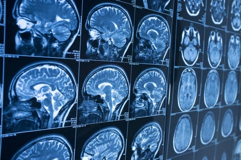 Tìm hiểu biểu hiện người bệnh alzheimer qua ảnh thực tế