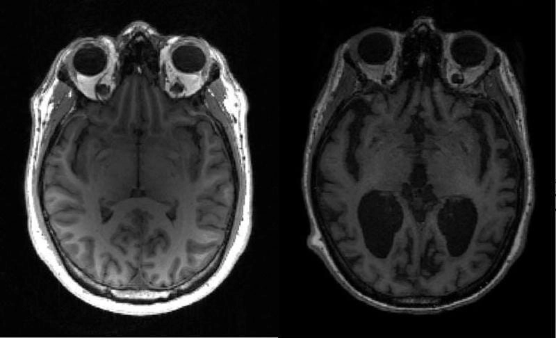 Xem chi tiết hình ảnh bệnh alzheimer dễ hiểu và chính xác