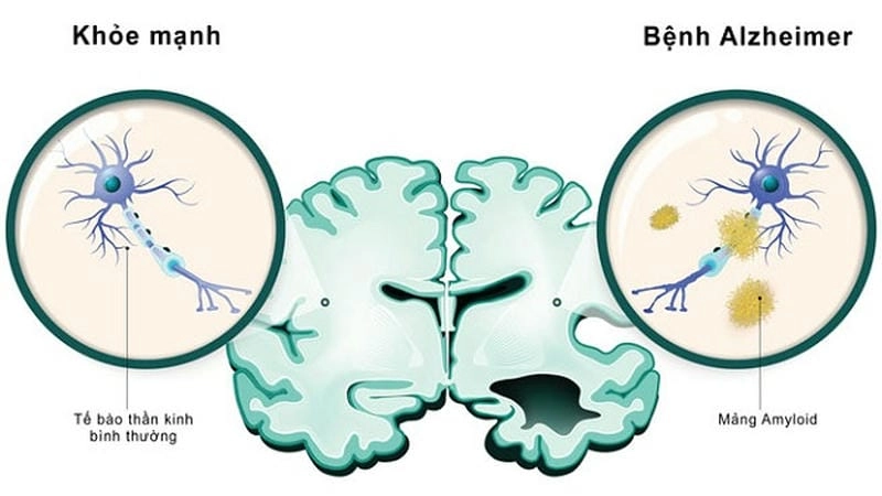 Nhận biết sớm bệnh alzheimer ở người cao tuổi qua hình ảnh