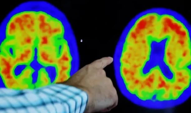 Quy trình chẩn đoán bệnh alzheimer minh họa bằng hình thực tế