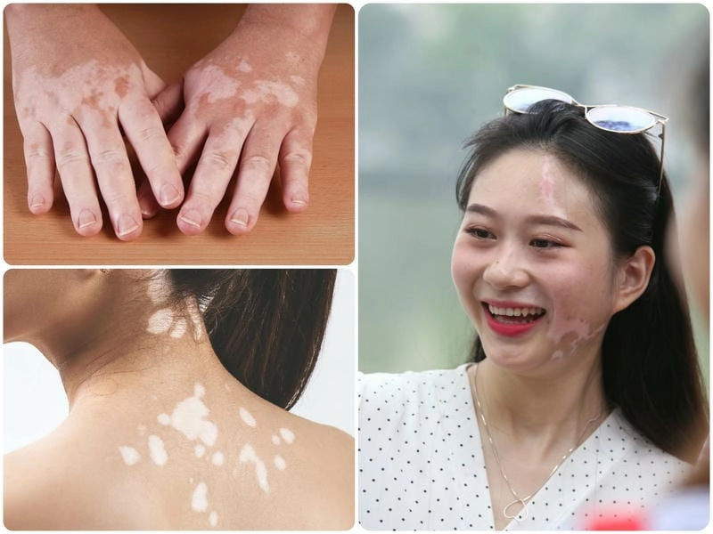 Khám phá hình ảnh bệnh bạch biến chi tiết rõ ràng