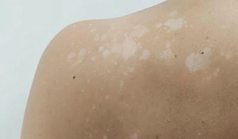 Thực tế về bệnh bạch biến ở trẻ qua ảnh