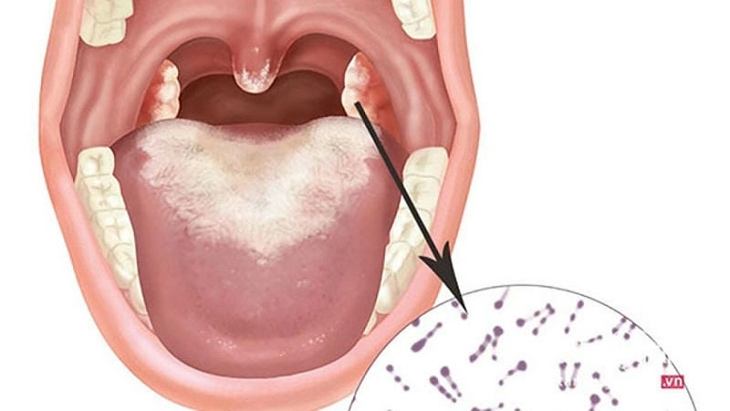 Nhận biết sớm dấu hiệu bệnh bạch biến qua ảnh