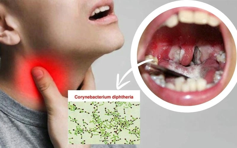 Xem rõ hình ảnh ban đầu của bệnh bạch biến ở da