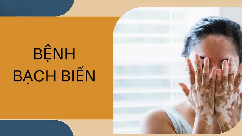 Hình ảnh bệnh bạch biến và triệu chứng nhận biết sớm