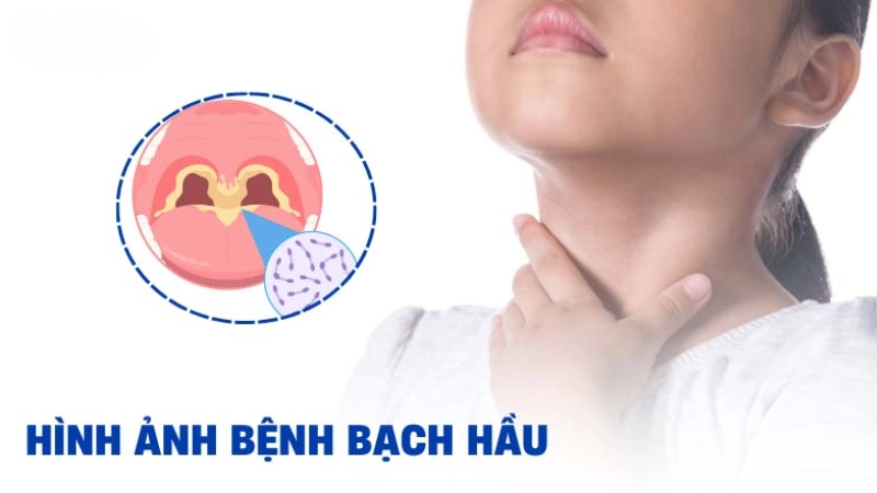 Hình ảnh bệnh bạch hầu rõ nét giúp nhận biết triệu chứng