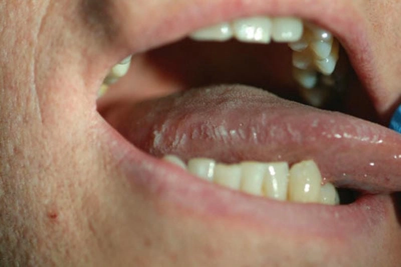 Tổng hợp biểu hiện bạch sản miệng bằng hình ảnh thật