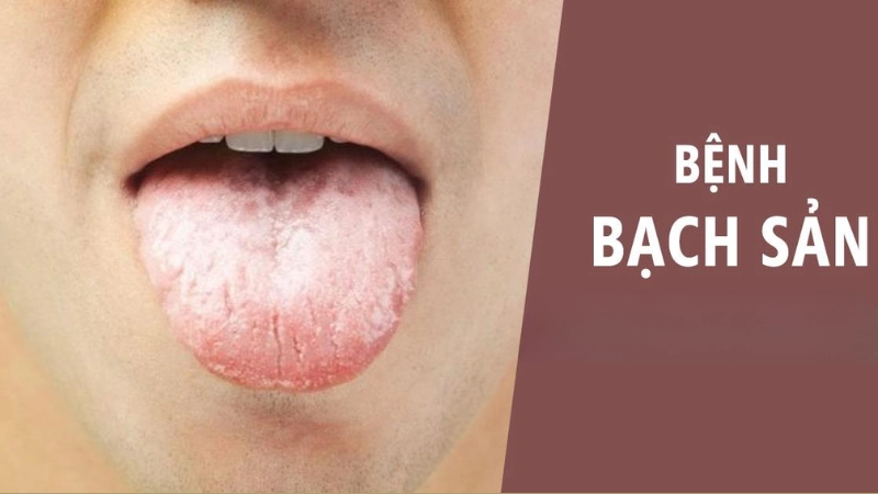 Nhận biết sớm qua hình ảnh bệnh bạch sản lưỡi chi tiết