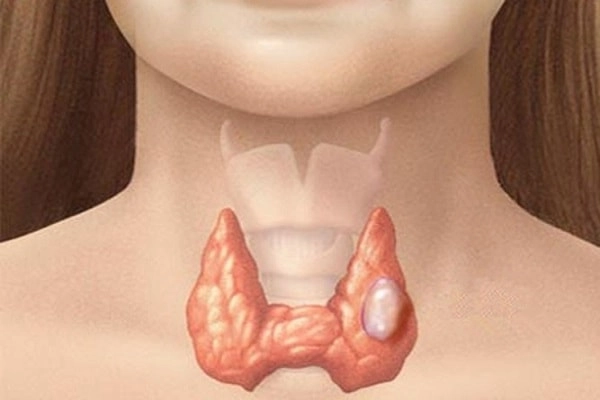 Hình ảnh minh họa bướu cổ đơn thuần trong thực tế