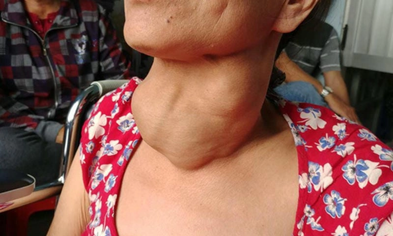 Khám phá ngay hình ảnh bướu cổ rõ ràng dưới góc nhìn y khoa