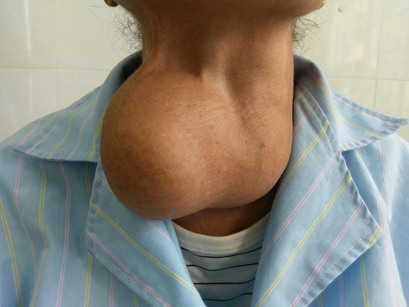 Tìm hiểu bướu cổ dạng đặc với minh họa từ ảnh lâm sàng