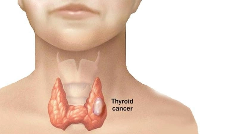 Nhận biết bướu cổ dạng nang qua hình ảnh bệnh bướu cổ