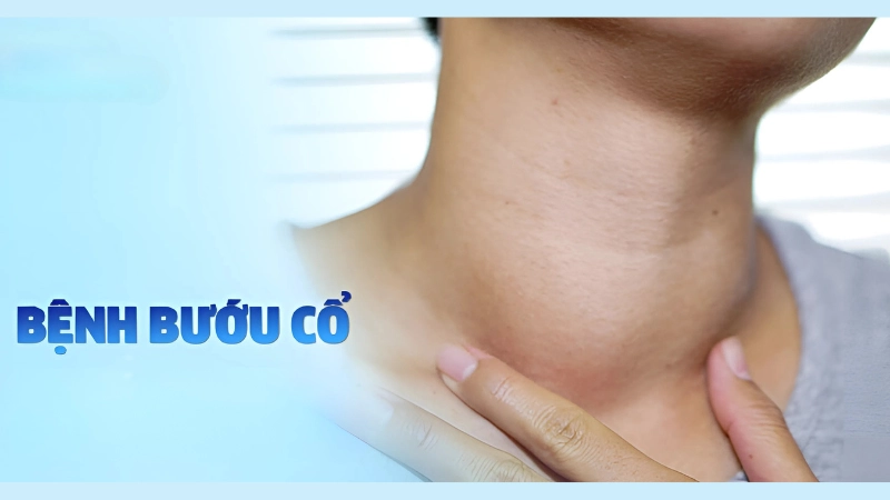 Tổng hợp hình ảnh bệnh bướu cổ từ nhẹ đến nặng