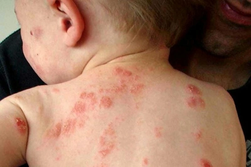 Xem chi tiết hình ảnh bé bị chàm và cách xử lý