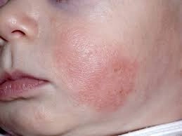 Cập nhật dấu hiệu trẻ con bị chàm ở mặt mới nhất