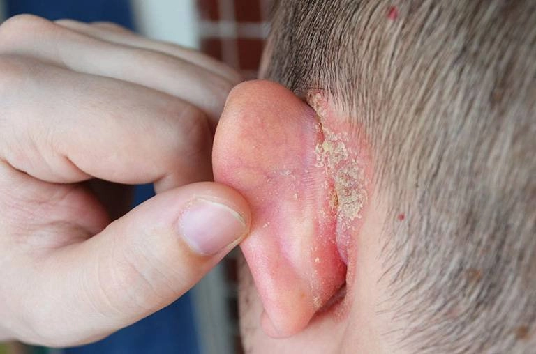 Xem thực tế hình ảnh bé sơ sinh bị chàm sữa cần biết