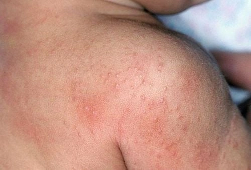 Cách chăm sóc trẻ bị chàm trên mặt đúng phương pháp