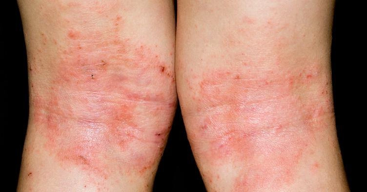 Nhận biết triệu chứng bệnh chàm khô ở mặt ở trẻ nhỏ