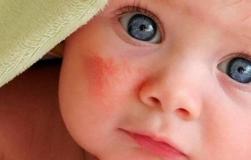Khám ngay biểu hiện bé bị chàm ở má thường gặp