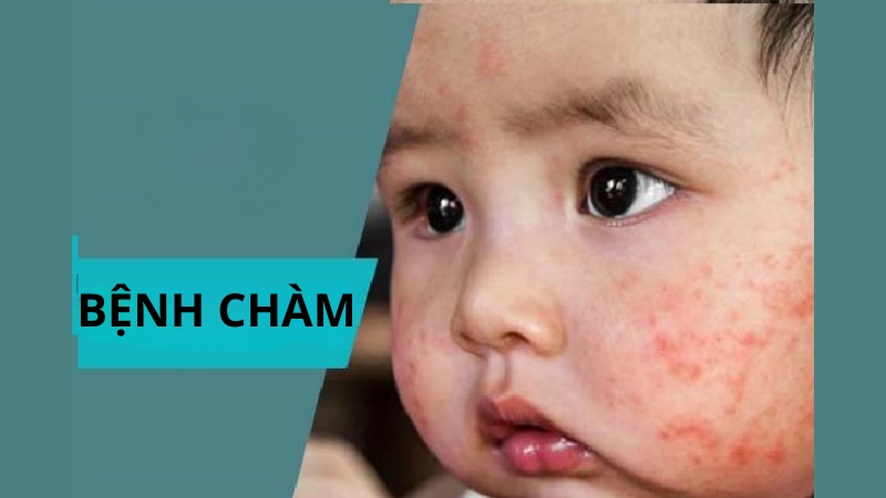 Chi tiết hình ảnh bệnh chàm ở trẻ em từ nhẹ đến nặng