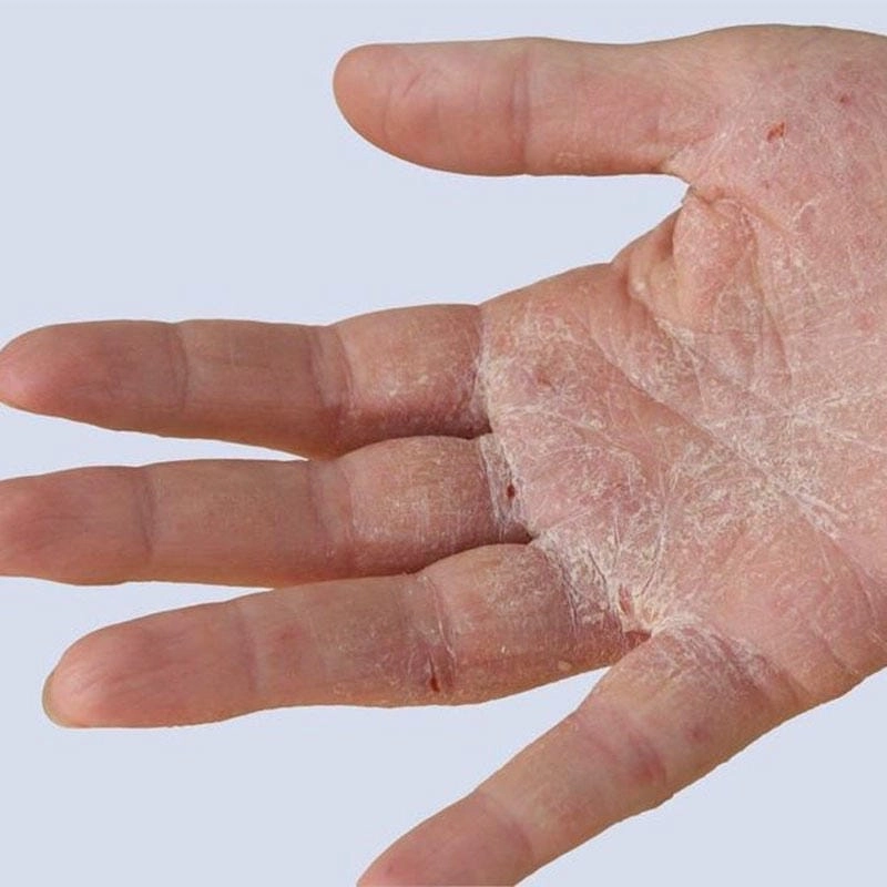 Dấu hiệu nhận biết sớm bệnh chàm tổ đỉa phổ biến