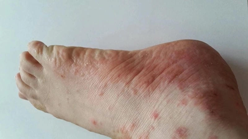 Bộ sưu tập ảnh bệnh chàm to đỉa qua từng giai đoạn