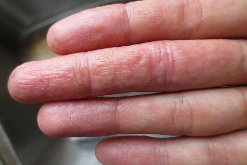 Góc nhìn thực tế từ ảnh bệnh chàm to đỉa ở người
