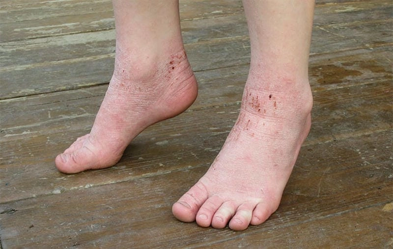 Bác sĩ khuyên dùng các cách trị chàm tổ đĩa hiệu quả